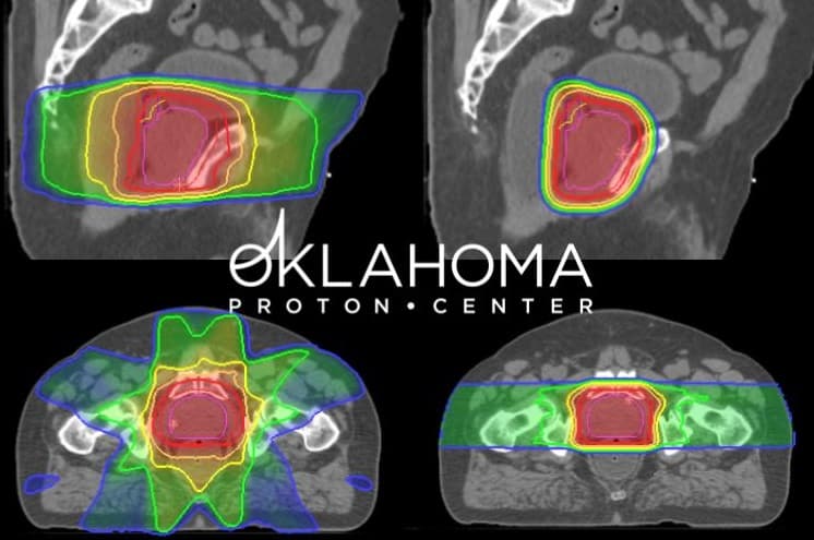 Benefits Of Proton Therapy For Prostate Cancer Oklahoma Cancer Center 9736